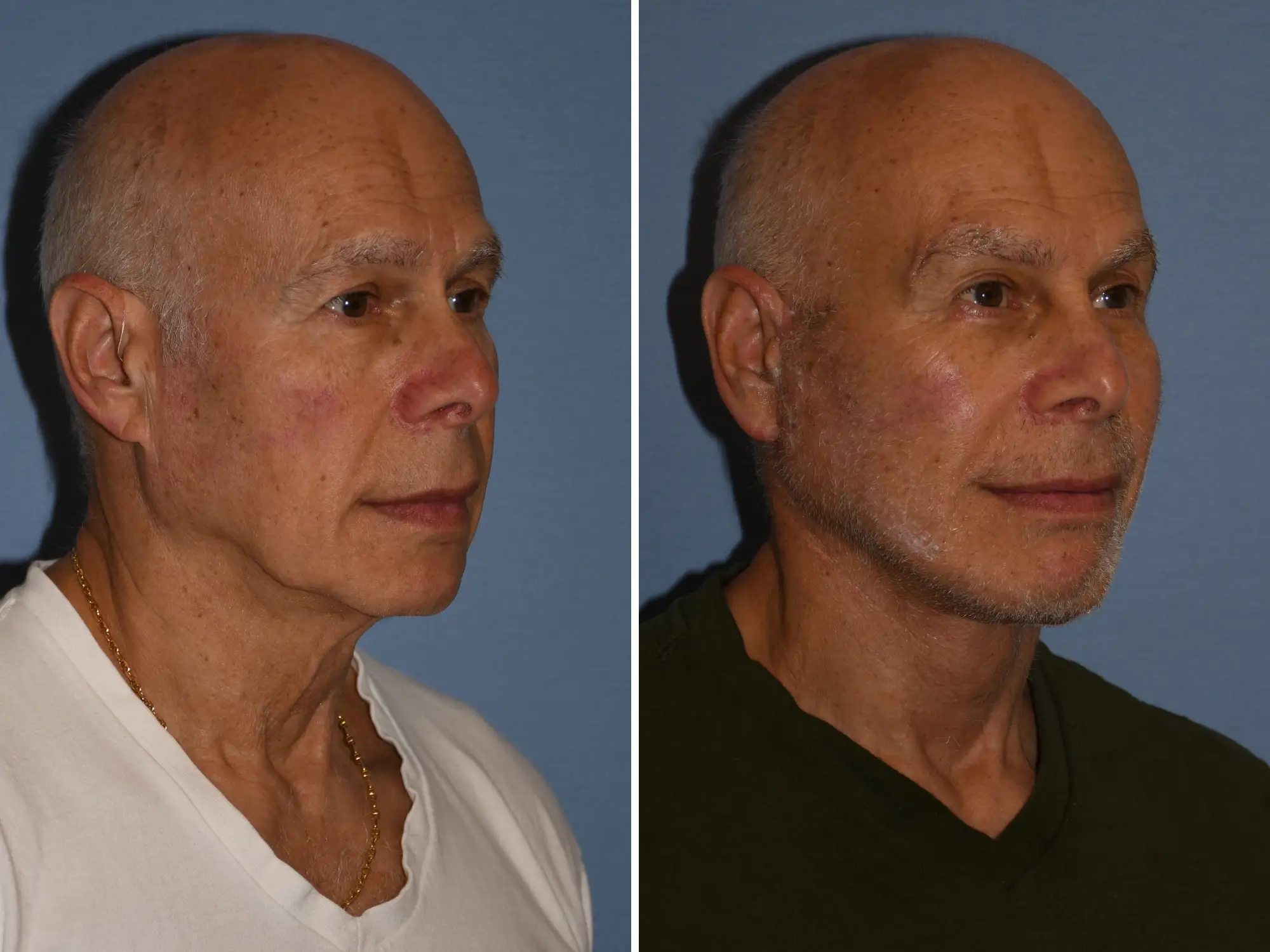 A man in his 70s before and after plastic surgery, including a facelift.