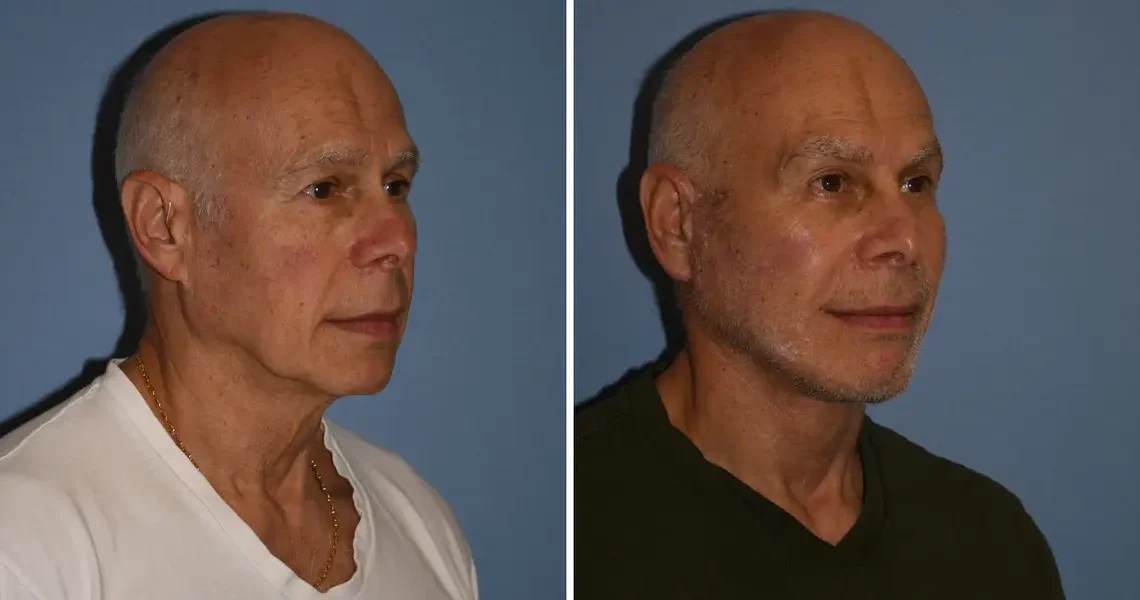 I’m a 72-year-old grandfather and spent $60,000 on a facelift and other cosmetic procedures. People now think I’m in my 50s.