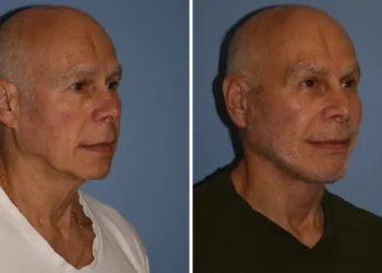I’m a 72-year-old grandfather and spent $60,000 on a facelift and other cosmetic procedures. People now think I’m in my 50s.