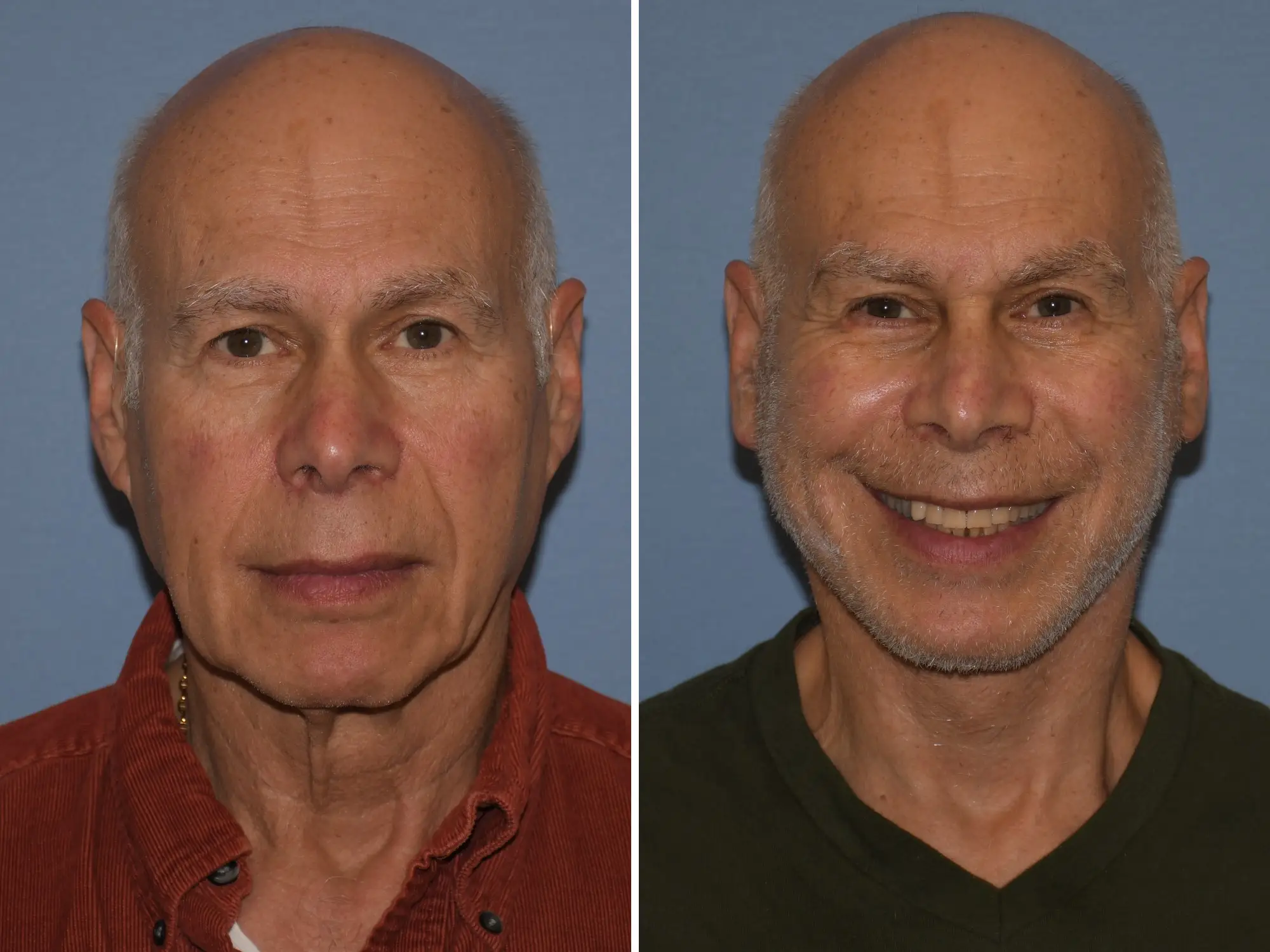 An older man before and after plastic surgery