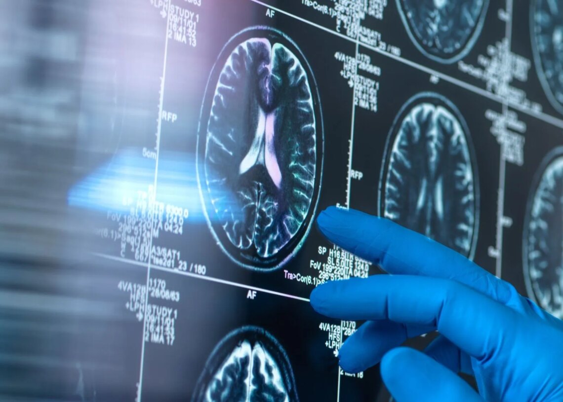 Did Scientists Just Discover a New Way to Fight Alzheimer’s Disease? Here’s Everything We Know.