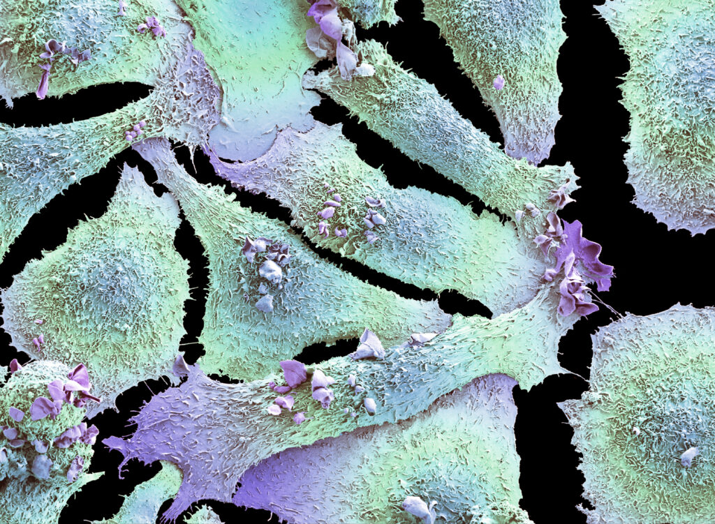 Beyond cigarettes: Uncovering the causes of lung cancer in nonsmokers