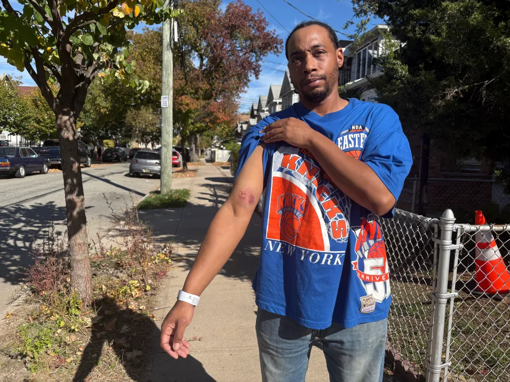Edward Grant showing the bruise on his arm.