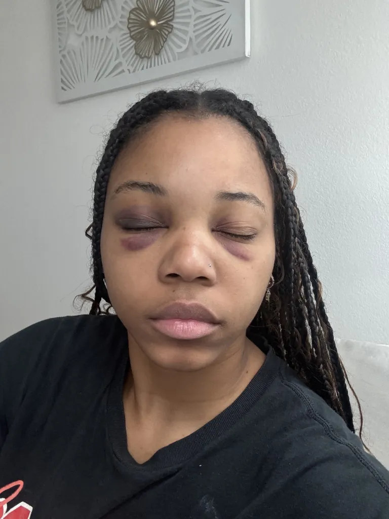 Eryn Kelise Bonner with bruised and swollen eyes.