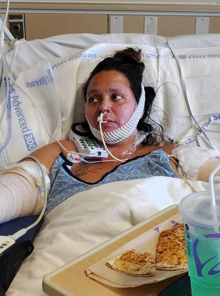 Frances Lopez in a hospital bed with bandages on her arms and face.