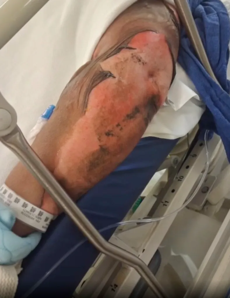 Frances Lopez in a hospital bed, showing severe burns on her arm and leg from an encampment fire.