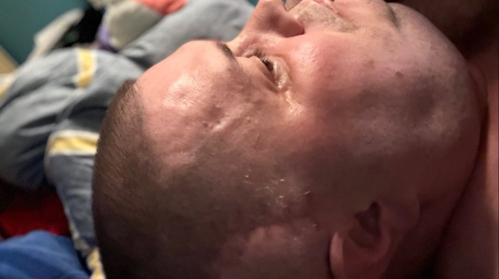 Close-up view of MasterChef star showing the physical toll of his brain tumor.