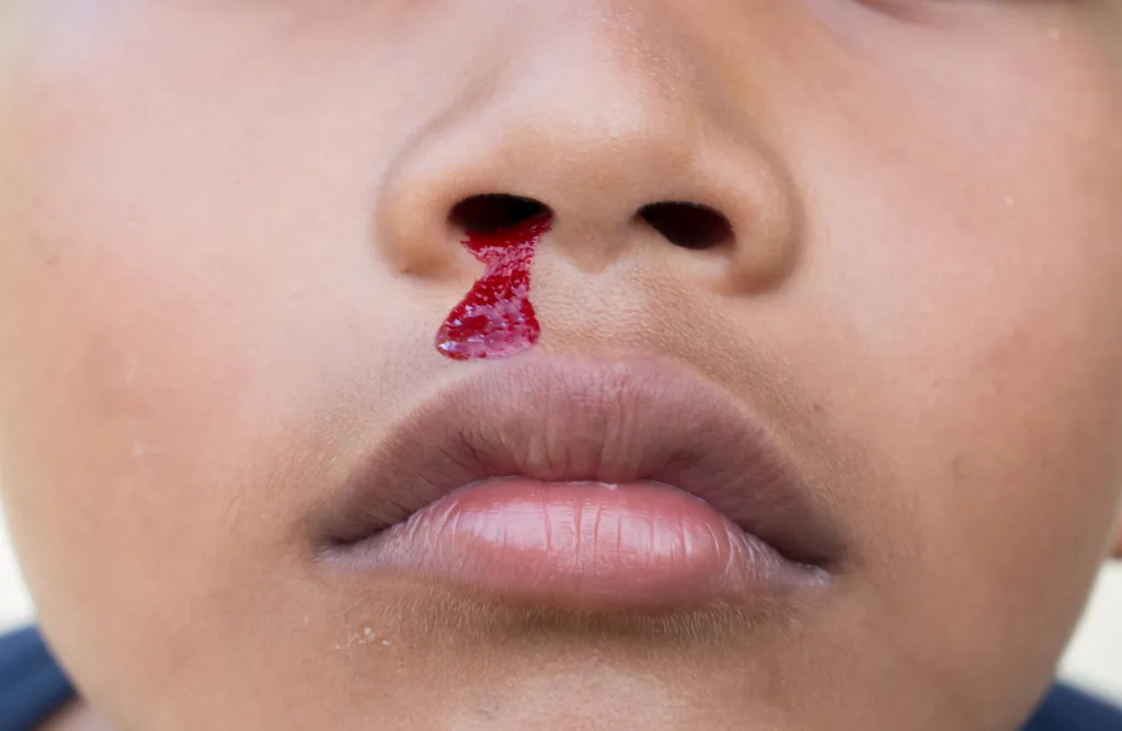 A close-up of a child's face experiencing a nosebleed, with blood flowing from the right nostril.