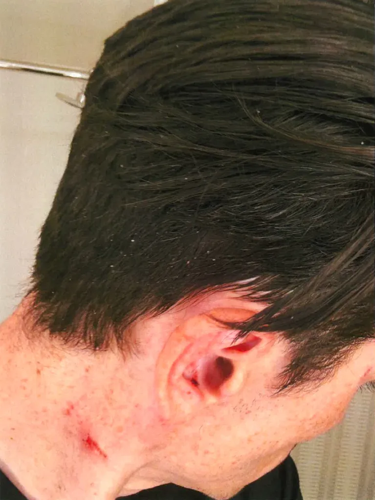 Close-up of a person's head showing a scratch on their neck and near their ear.