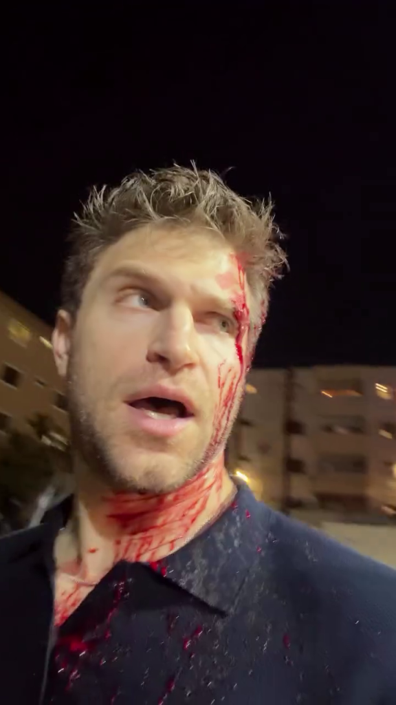 Keegan Allen with blood on his face and neck following an attack.