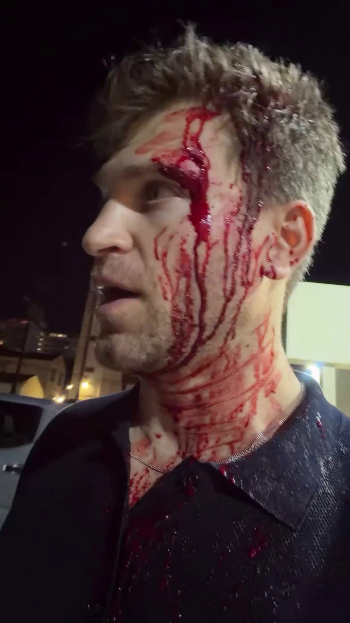 Actor Keegan Allen with blood on his face and neck following an attack.