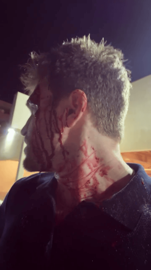 Keegan Allen covered in blood following a brutal attack.