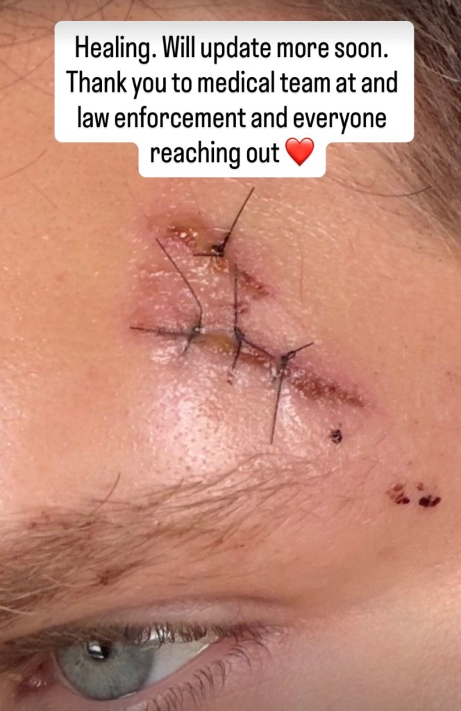 Keegan Allen's injured forehead with stitches above his eyebrow.