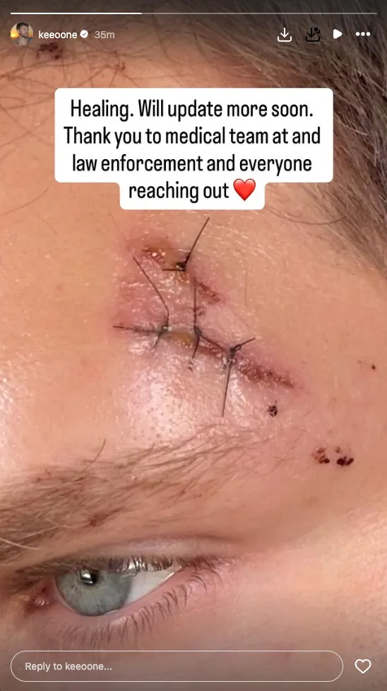 Close-up of Keegan Allen's stitched-up forehead after a brutal attack.