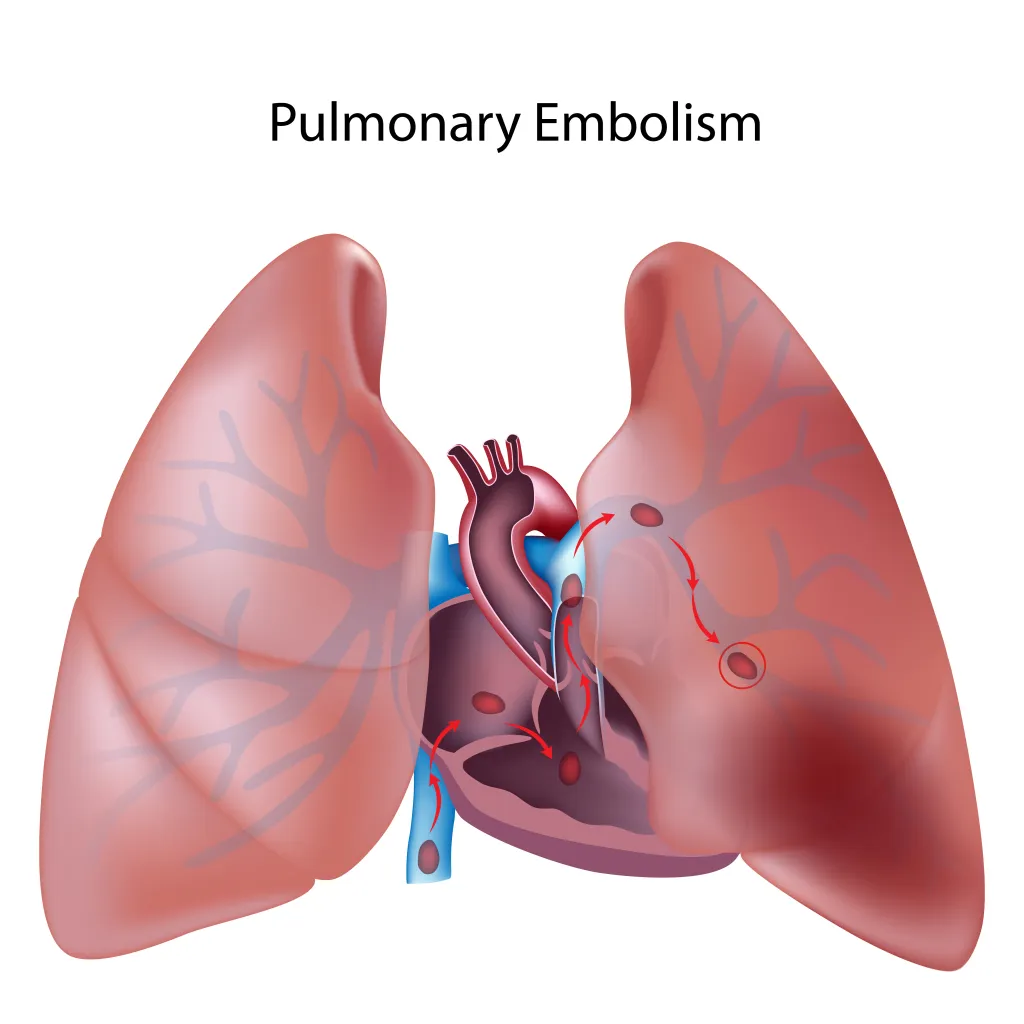 Illustration showing a blood clot traveling from the heart into the pulmonary arteries of the lung, causing a pulmonary embolism.
