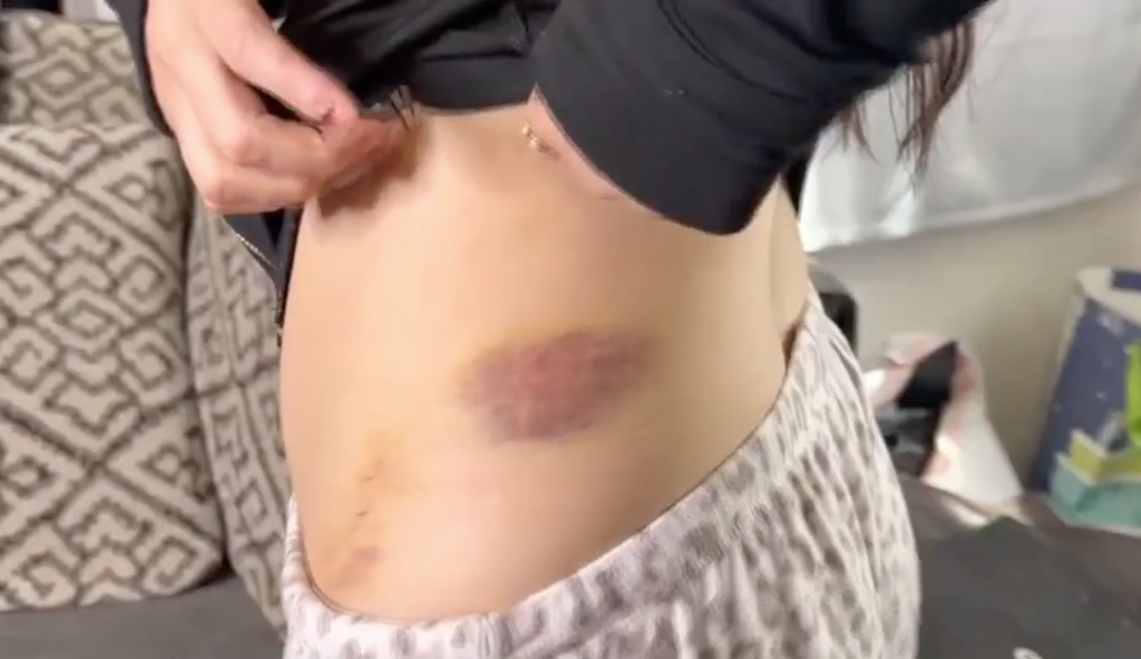 Samantha Baez-Vargas showing a large bruise on her side following an attack.