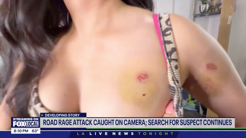 Samantha Baez-Vargas showing bite marks and bruising on her chest and arm.