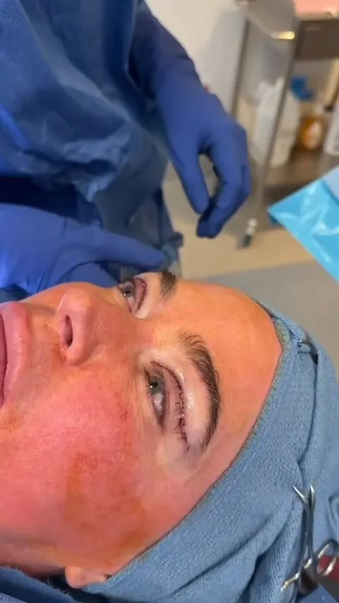 Teddi Mellencamp showing her healing eyelids after undergoing plastic surgery treatment.