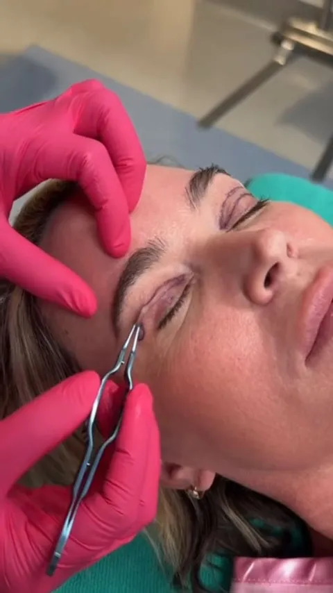 Teddi Mellencamp undergoing a plastic surgery procedure on her eyelids.