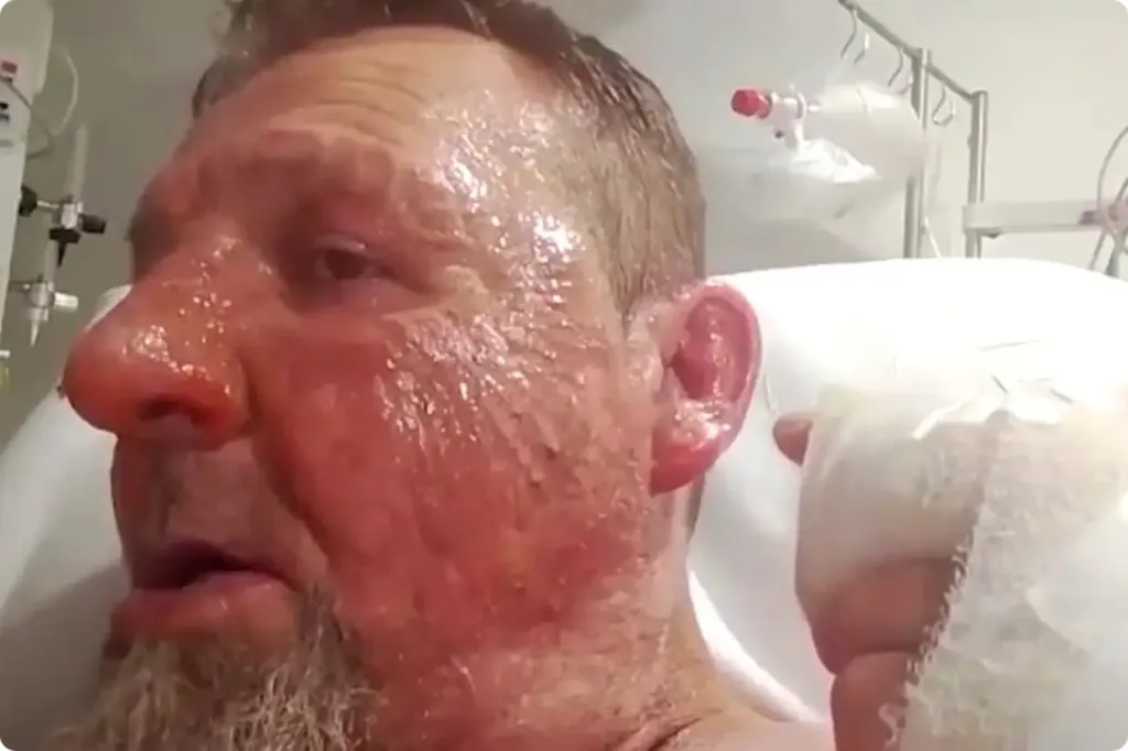 Randovan Banic with serious burns on his face and ear following a petrol attack inside a hospital.